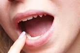 Sùi mào gà ở lưỡi biểu hiện thế nào? Sùi mào gà ở lưỡi biểu hiện thế nào?