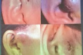 Mổ lấy tăm nằm trong tai bệnh nhân hơn một năm Mổ lấy tăm nằm trong tai bệnh nhân hơn một năm