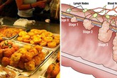 5 nhóm người dễ mắc ung thư đại trực tràng, hy vọng không có bạn trong đó 5 nhóm người dễ mắc ung thư đại trực tràng, hy vọng không có bạn trong đó