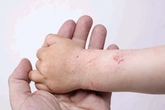 Nhập viện vì bệnh ngoài da lúc trở mùa Nhập viện vì bệnh ngoài da lúc trở mùa