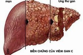 Việt Nam có 3 loại thuốc viêm gan C giá bằng 1% giá tại Mỹ Việt Nam có 3 loại thuốc viêm gan C giá bằng 1% giá tại Mỹ