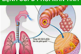Những dấu hiệu phổ biến của bệnh phổi tắc nghẽn mãn tính mà bạn cần biết Những dấu hiệu phổ biến của bệnh phổi tắc nghẽn mãn tính mà bạn cần biết