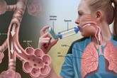 Trời trở lạnh, những người có tiền sử bị hen phế quản cần lưu ý những điều sau Trời trở lạnh, những người có tiền sử bị hen phế quản cần lưu ý những điều sau