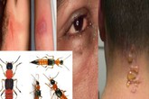 Độc tố kiến ba khoang độc hơn nọc rắn, cẩn thận xử lý kẻo rước hoạ vào thân Độc tố kiến ba khoang độc hơn nọc rắn, cẩn thận xử lý kẻo rước hoạ vào thân