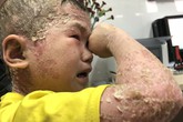 Rớt nước mắt hình ảnh cậu bé toàn thân mọc mụn mủ, lở loét Rớt nước mắt hình ảnh cậu bé toàn thân mọc mụn mủ, lở loét