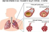 Chế độ ăn khoa học cho người bị bệnh phổi tắc nghẽn mãn tính Chế độ ăn khoa học cho người bị bệnh phổi tắc nghẽn mãn tính