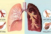 Những người có nguy cơ cao mắc bệnh phổi tắc nghẽn mạn tính Những người có nguy cơ cao mắc bệnh phổi tắc nghẽn mạn tính