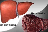 Ung thư gan dẫn đầu các ca bệnh ung thư tại Việt Nam Ung thư gan dẫn đầu các ca bệnh ung thư tại Việt Nam