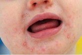 Con mắc tay chân miệng nặng thêm vì những sai lầm này của người lớn Con mắc tay chân miệng nặng thêm vì những sai lầm này của người lớn
