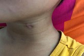 Nghịch súng, anh 9 tuổi bắn xuyên cổ em trai 6 tuổi Nghịch súng, anh 9 tuổi bắn xuyên cổ em trai 6 tuổi