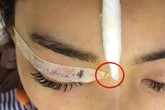 Vì sao tiêm chất làm đầy filler vào mũi lại gây mù mắt? Vì sao tiêm chất làm đầy filler vào mũi lại gây mù mắt?