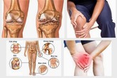 Cảnh báo thoái hóa khớp và cột sống ở tuổi 20 Cảnh báo thoái hóa khớp và cột sống ở tuổi 20