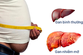 Những quan niệm sai hoàn toàn về gan nhiễm mỡ Những quan niệm sai hoàn toàn về gan nhiễm mỡ