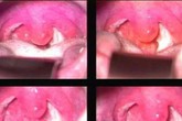 3 bệnh về họng hay gặp trong mùa lạnh 3 bệnh về họng hay gặp trong mùa lạnh