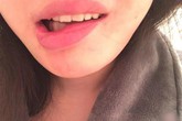 Bỏ hơn 100 triệu đi trùng tu nhan sắc, cô gái trẻ khóc ròng khi nhận về cái miệng lệch, sợ không lấy được chồng vì di chứng thẩm mỹ Bỏ hơn 100 triệu đi trùng tu nhan sắc, cô gái trẻ khóc ròng khi nhận về cái miệng lệch, sợ không lấy được chồng vì di chứng thẩm mỹ