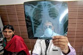 WHO: Lao vẫn là căn bệnh truyền nhiễm nguy hiểm nhất WHO: Lao vẫn là căn bệnh truyền nhiễm nguy hiểm nhất