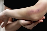 Mẹo sơ cứu những thương tổn thường gặp mà không cần đến bác sĩ Mẹo sơ cứu những thương tổn thường gặp mà không cần đến bác sĩ