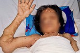 Giải cứu nữ bệnh nhân U70 hơn nửa cuộc đời sống cảnh "đại bàng gãy cánh" Giải cứu nữ bệnh nhân U70 hơn nửa cuộc đời sống cảnh "đại bàng gãy cánh"