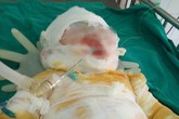 Bé gái 3 tuổi ngã vào hố vôi ở Nghệ An đã qua đời Bé gái 3 tuổi ngã vào hố vôi ở Nghệ An đã qua đời