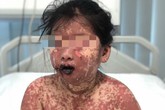 Mắc hội chứng hiếm gặp, bé gái 7 tuổi ở Tiền Giang có làn da như bỏng nặng Mắc hội chứng hiếm gặp, bé gái 7 tuổi ở Tiền Giang có làn da như bỏng nặng