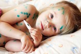 Cẩn trọng nhiễm trùng máu khi tùy tiện dùng Đông y trị thủy đậu Cẩn trọng nhiễm trùng máu khi tùy tiện dùng Đông y trị thủy đậu
