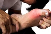 Người nào dễ bị bệnh gút? Người nào dễ bị bệnh gút?