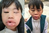 Bé 6 tuổi môi sưng phồng, phải nhập viện cấp cứu sau 3 phút ăn kẹo mua ở cổng trường Bé 6 tuổi môi sưng phồng, phải nhập viện cấp cứu sau 3 phút ăn kẹo mua ở cổng trường