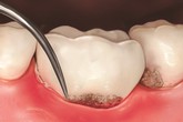 Nha chu dẫn đến mất răng! Bạn đã lường trước? Nha chu dẫn đến mất răng! Bạn đã lường trước?