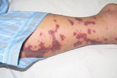 Viêm não mô cầu có thể giết chết người khỏe mạnh trong 24 giờ Viêm não mô cầu có thể giết chết người khỏe mạnh trong 24 giờ