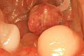 Nguyên PGĐ Bệnh viện K: Loại ung thư di truyền nhiều nhất, cần tầm soát sớm kẻo muộn Nguyên PGĐ Bệnh viện K: Loại ung thư di truyền nhiều nhất, cần tầm soát sớm kẻo muộn