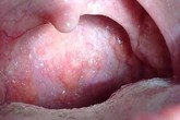 Nhớ các dấu hiệu ung thư vòm họng giai đoạn đầu, cơ hội sống sót lên tới 72% Nhớ các dấu hiệu ung thư vòm họng giai đoạn đầu, cơ hội sống sót lên tới 72%
