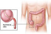 Những dấu hiệu viêm ruột thừa nhất định không được chủ quan Những dấu hiệu viêm ruột thừa nhất định không được chủ quan