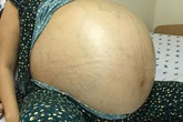 Mang khối u 50kg, bụng người phụ nữ trương phình muốn nổ tung Mang khối u 50kg, bụng người phụ nữ trương phình muốn nổ tung