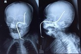 Hà Nội: Tai nạn hi hữu, bé gái 8 tháng bị thanh sắt rỉ xuyên thẳng hộp sọ Hà Nội: Tai nạn hi hữu, bé gái 8 tháng bị thanh sắt rỉ xuyên thẳng hộp sọ