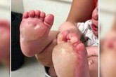 Phát hiện chân con có vết phồng rộp lớn, bà mẹ nghi ngờ nên báo cảnh sát và phát hiện ra sự thật rùng rợn về người trông trẻ Phát hiện chân con có vết phồng rộp lớn, bà mẹ nghi ngờ nên báo cảnh sát và phát hiện ra sự thật rùng rợn về người trông trẻ