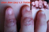 Cách cấp cứu khi bị đứt lìa chân, tay Cách cấp cứu khi bị đứt lìa chân, tay