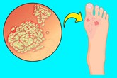 Thêm 5 dấu hiệu kì cục ở chân cảnh báo những rối loạn về sức khỏe không thể coi thường Thêm 5 dấu hiệu kì cục ở chân cảnh báo những rối loạn về sức khỏe không thể coi thường