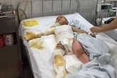 Nỗi đau tột cùng của cậu bé dân tộc bị bỏng nặng toàn thân Nỗi đau tột cùng của cậu bé dân tộc bị bỏng nặng toàn thân