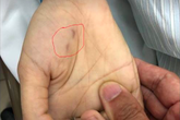 Mùa nắng nóng, cao điểm bệnh dại gia tăng Mùa nắng nóng, cao điểm bệnh dại gia tăng