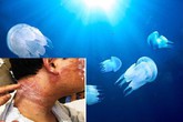 Sứa đốt nguy hiểm tính mạng nếu không biết cách xử lý Sứa đốt nguy hiểm tính mạng nếu không biết cách xử lý