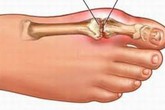 Những thực phẩm người bị bệnh gút cần tuyệt đối tránh Những thực phẩm người bị bệnh gút cần tuyệt đối tránh