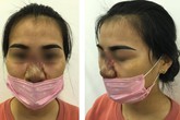 Chị em gặp họa vì muốn làm đẹp tức thì, chuyên gia cảnh báo tuyệt đối không tiêm filler nâng mũi ở những cơ sở spa Chị em gặp họa vì muốn làm đẹp tức thì, chuyên gia cảnh báo tuyệt đối không tiêm filler nâng mũi ở những cơ sở spa