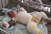 Xót xa cậu bé 3 tuổi khổ sở vì di chứng bỏng nước sôi kinh hoàng Xót xa cậu bé 3 tuổi khổ sở vì di chứng bỏng nước sôi kinh hoàng