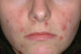 Kinh hoàng với chứng viêm da Demodex Kinh hoàng với chứng viêm da Demodex