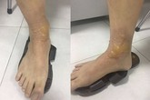 Đi massage quý ông ở Hà Nội bị bỏng rộp chân Đi massage quý ông ở Hà Nội bị bỏng rộp chân