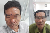 Hai nam bệnh nhân phát hiện ung thư từ lần đi đốt laze thẩm mỹ nốt ruồi lạ trên mặt Hai nam bệnh nhân phát hiện ung thư từ lần đi đốt laze thẩm mỹ nốt ruồi lạ trên mặt