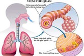 Chuyên gia cảnh báo bệnh viêm tiểu phế quản ở trẻ khi thời tiết giao mùa Chuyên gia cảnh báo bệnh viêm tiểu phế quản ở trẻ khi thời tiết giao mùa