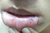 Nốt tròn trong suốt ở môi, bệnh gì? Nốt tròn trong suốt ở môi, bệnh gì?