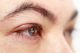 Cần làm gì khi mắt bị dị ứng? Cần làm gì khi mắt bị dị ứng?