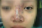 Nữ sinh mù mắt khi tiêm filler: Tiết lộ từ bác sĩ điều trị Nữ sinh mù mắt khi tiêm filler: Tiết lộ từ bác sĩ điều trị